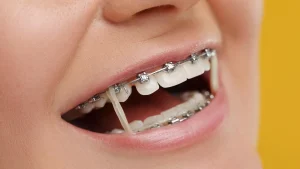 Braces