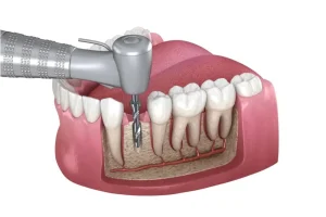 Root canal treatment