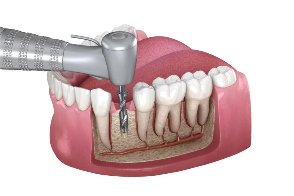 Root canal treatment