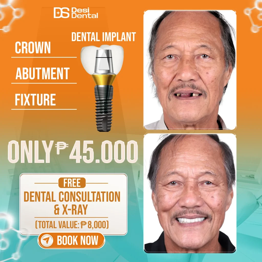 All-on-4 and All-on-6 Dental Implant price
