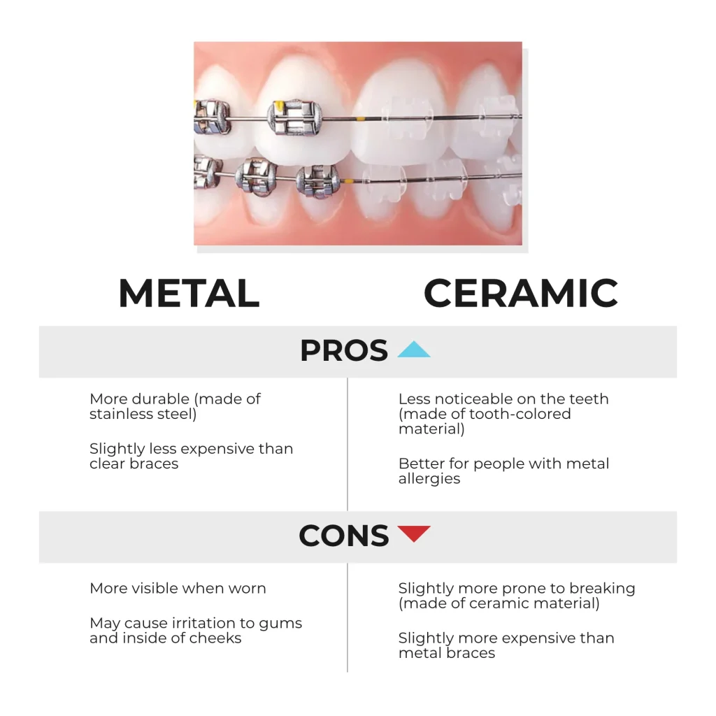 Ceramic Braces vs Metal Braces