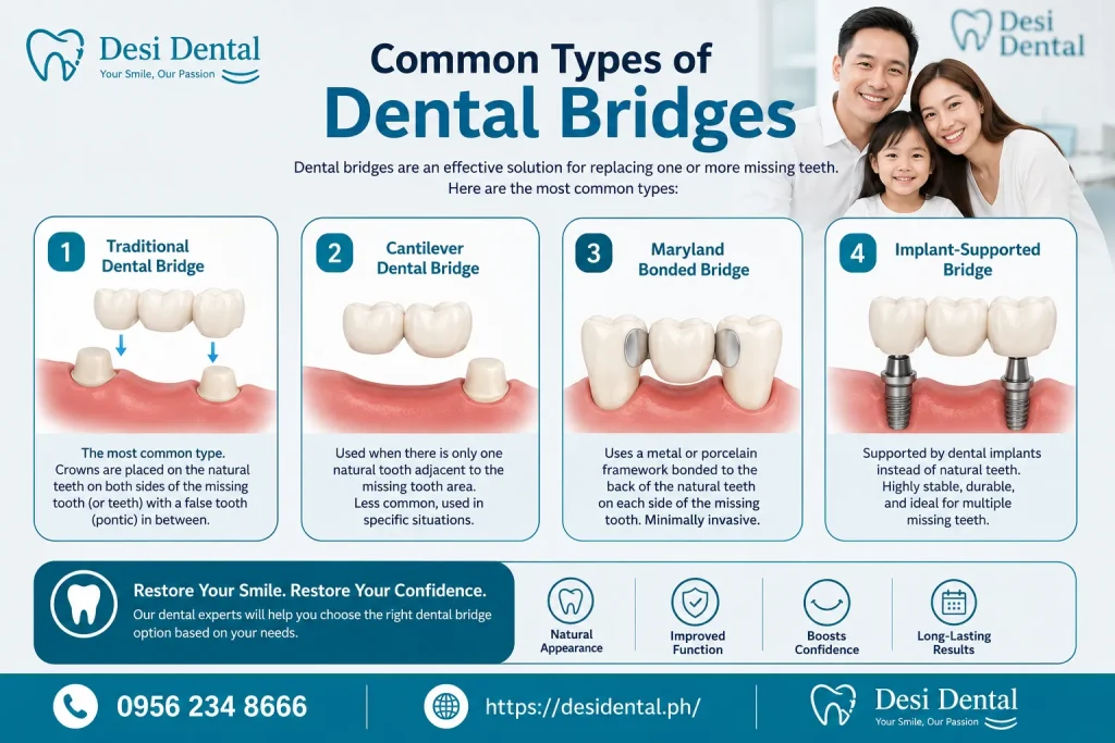 Common Types of Dental Bridges