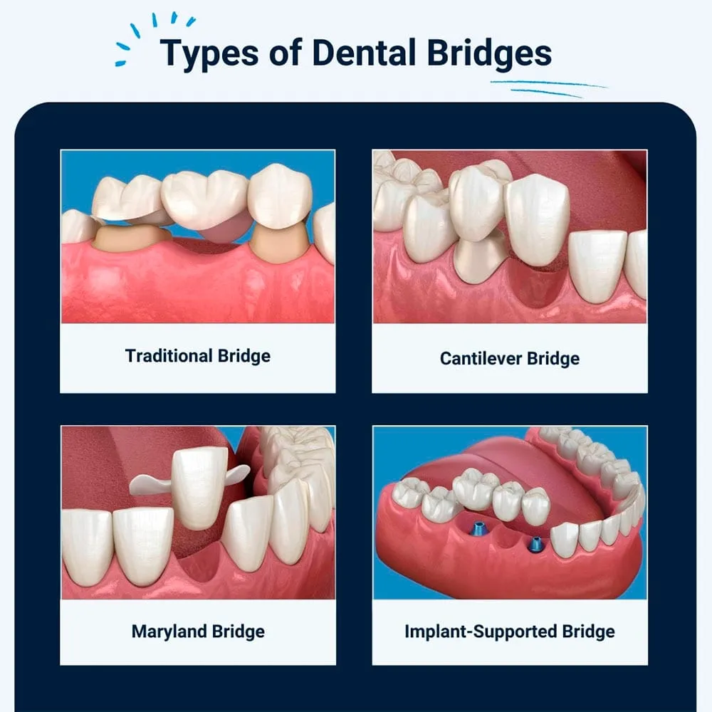 Common Types of Dental Bridges