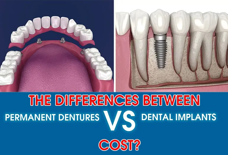Cost Comparison Dentures vs Implants