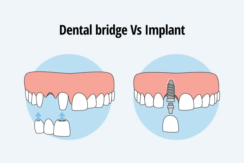 Dental Bridge vs Implant