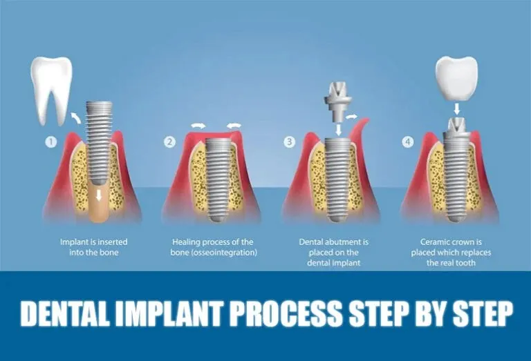 The Dental Implant Procedure