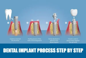 Dental Implant Procedure
