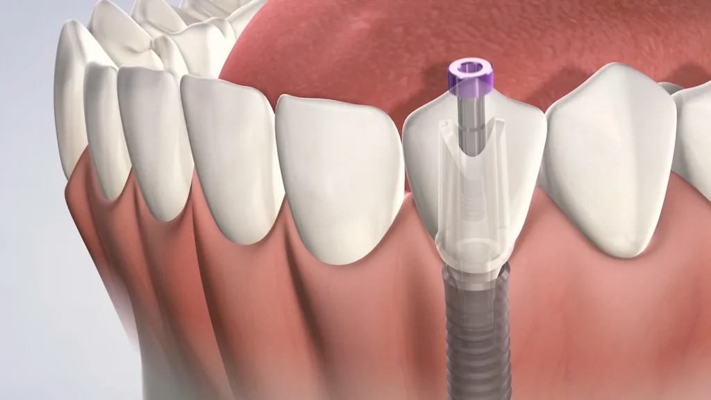 Dental Implants Is It Painful
