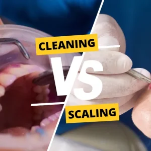 Dental Scaling (Teeth Cleaning)