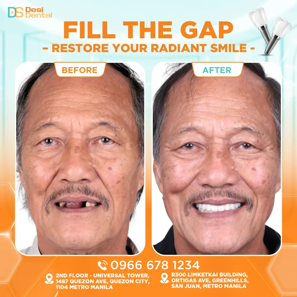Dental implants before and after pictures