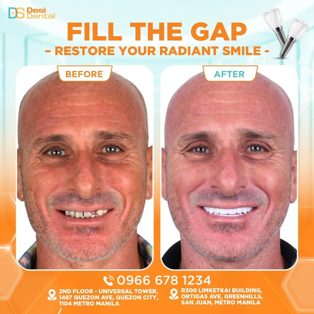 Dental implants before and after pictures