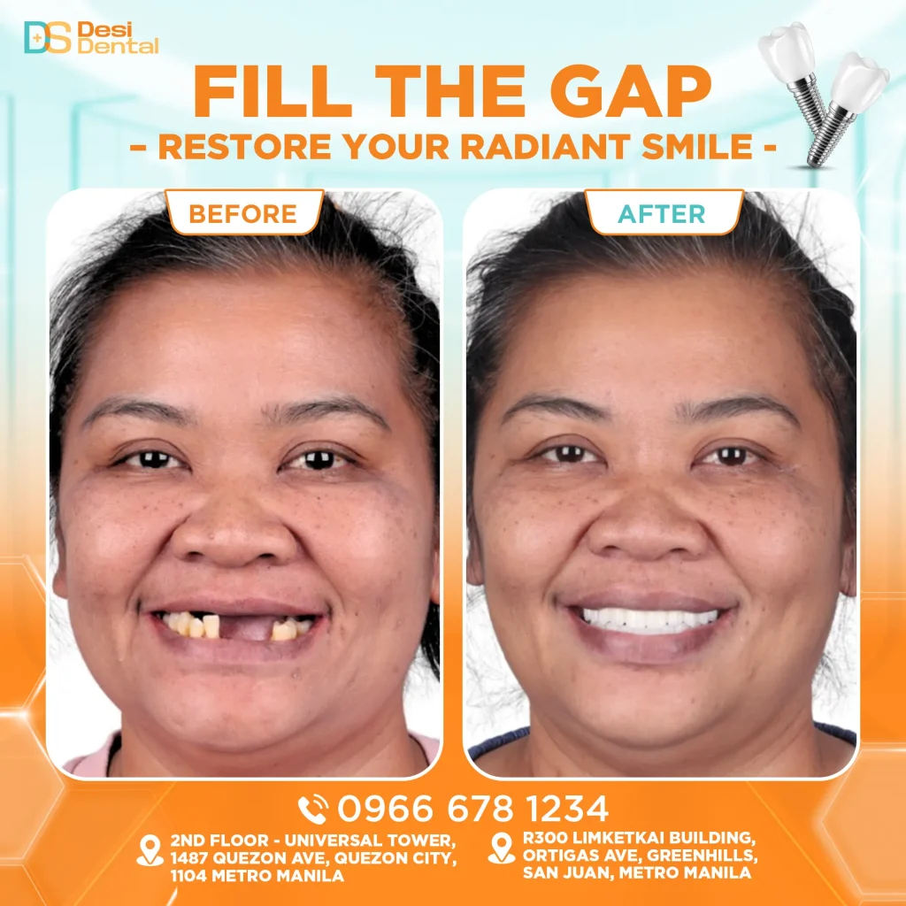 Dental implants before and after pictures