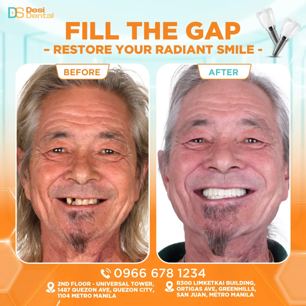 Dental implants before and after pictures