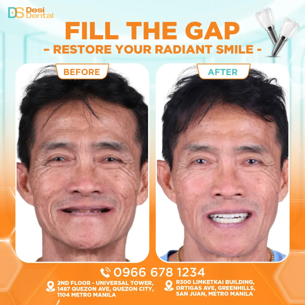 Dental implants before and after pictures