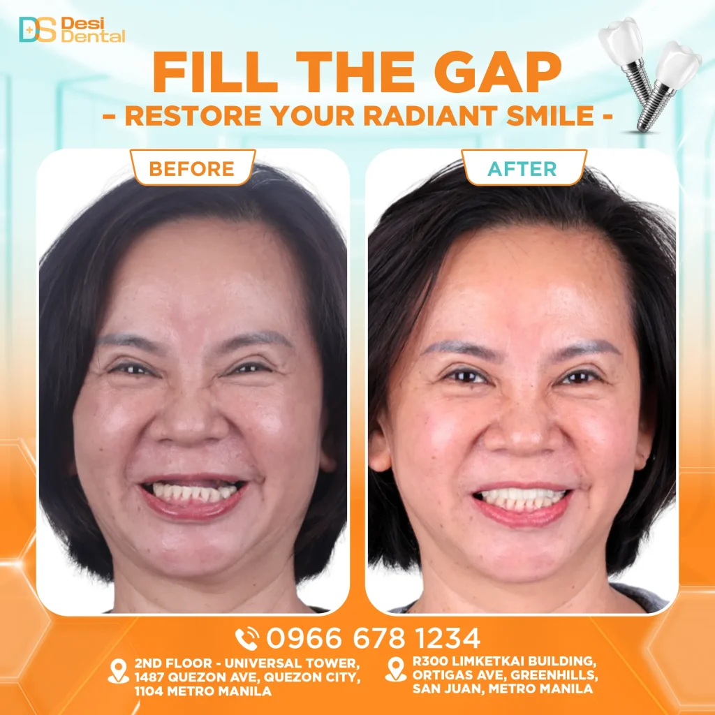 Dental implants before and after pictures