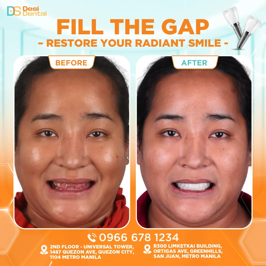 Dental implants before and after pictures