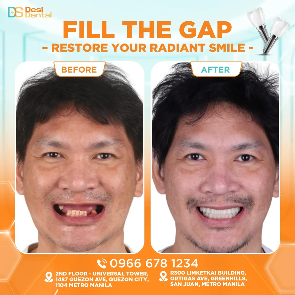 Dental implants before and after pictures