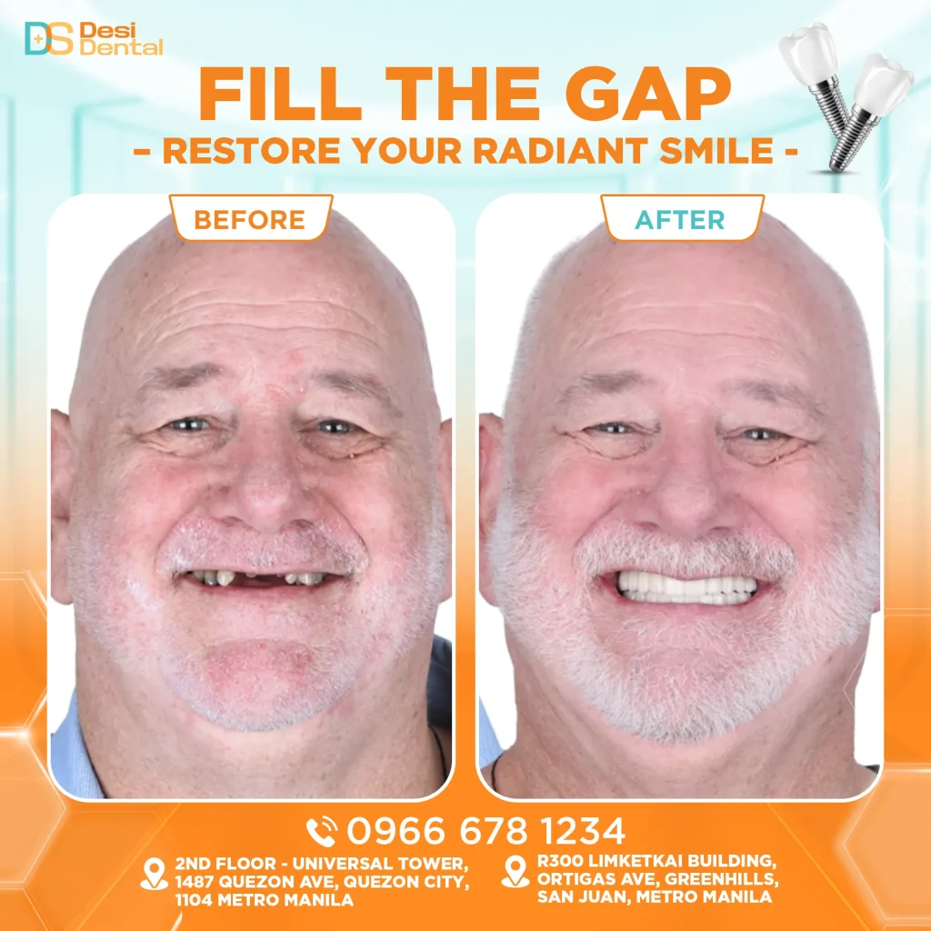 Dental implants before and after pictures