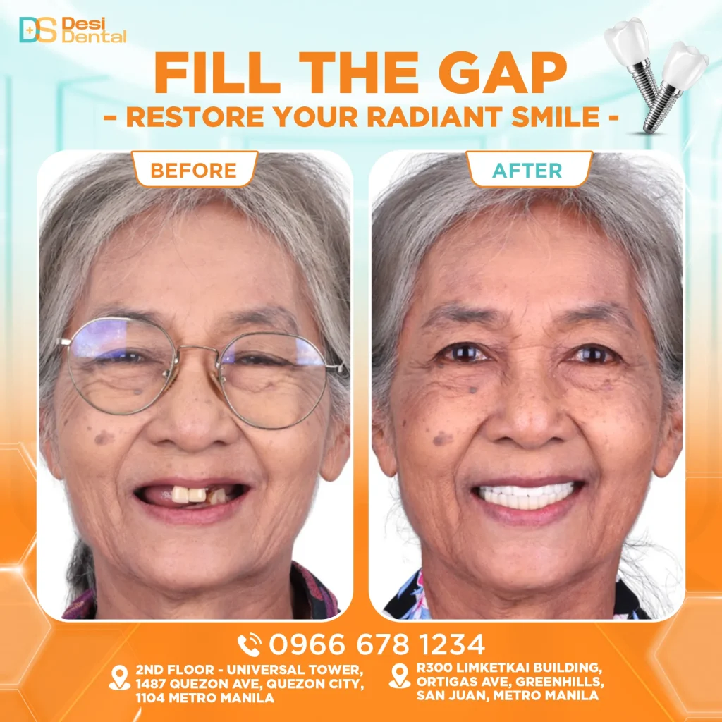 Dental implants before and after pictures