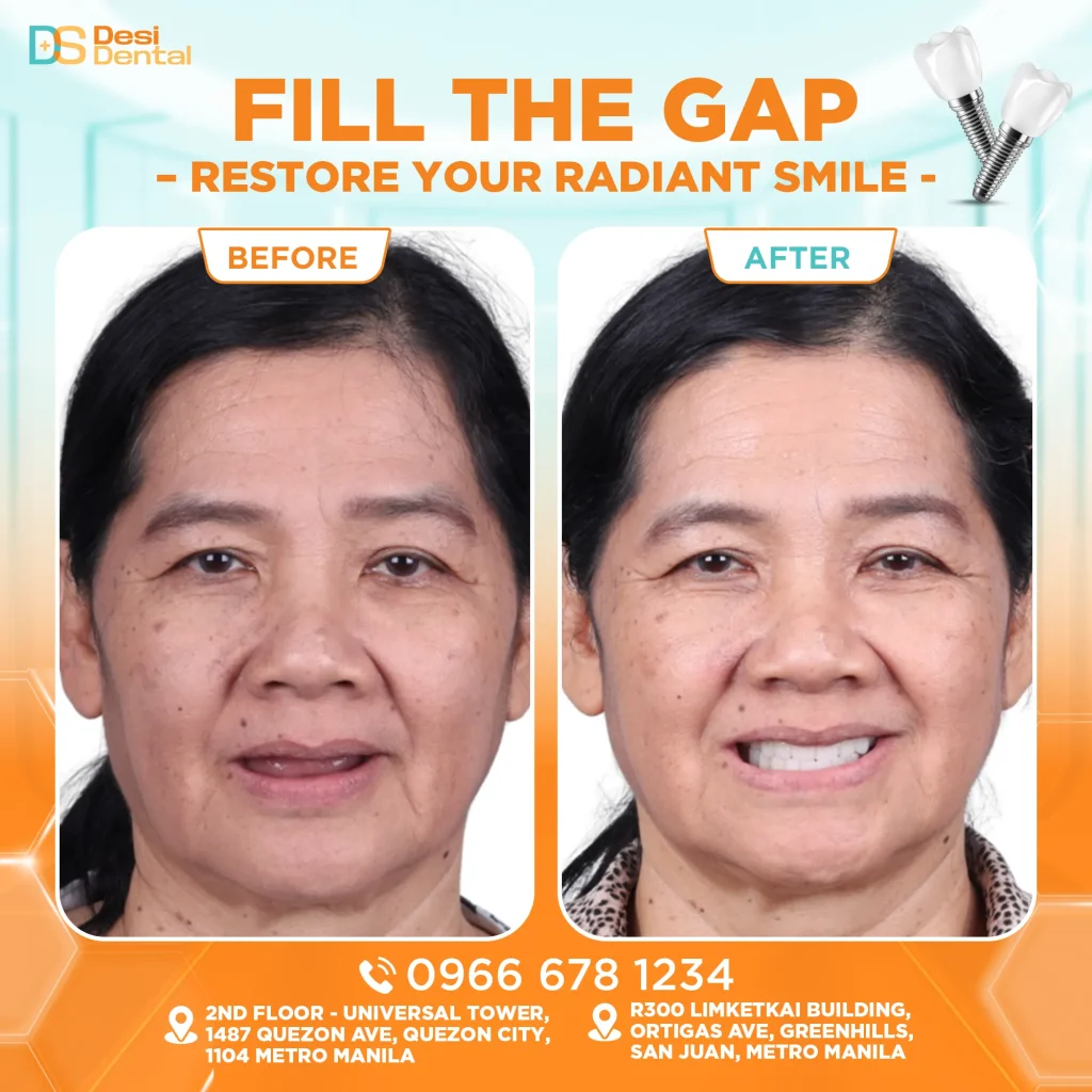 Dental implants before and after pictures