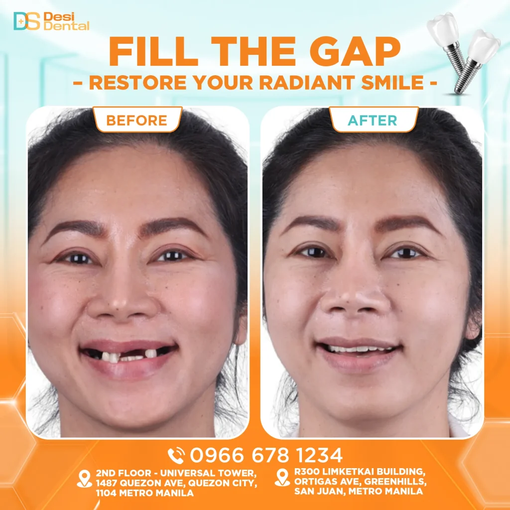 Dental implants before and after pictures