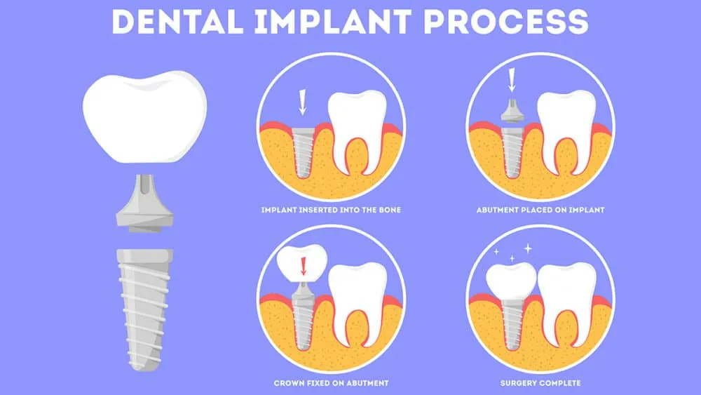 How Do Denture Implants Work