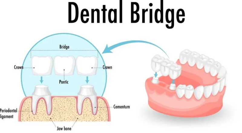 How Long Can a Dental Bridge Last
