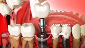 Implant Crown