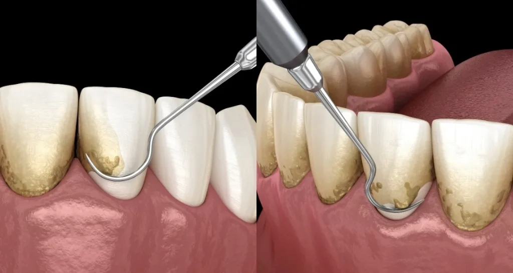 Important Things to Know Before Getting Deep Cleaning Teeth