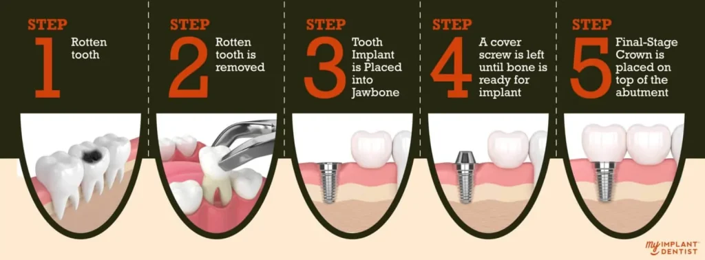 The Dental Implant Treatment Process