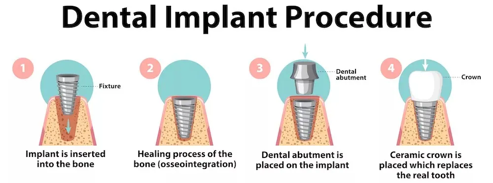 The Implant Crown Treatment Process