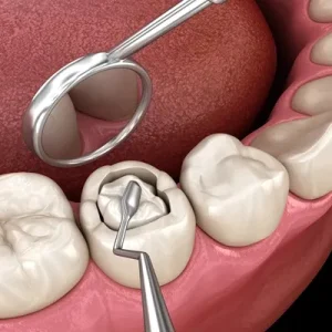 Tooth Filling