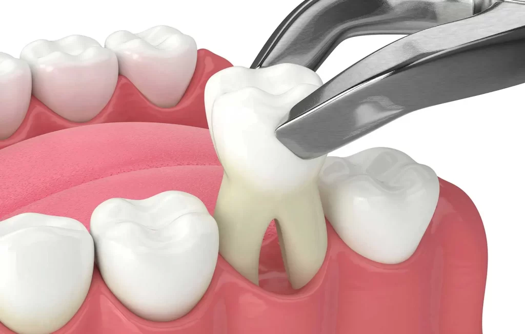 What Affects the Cost of Tooth Extraction