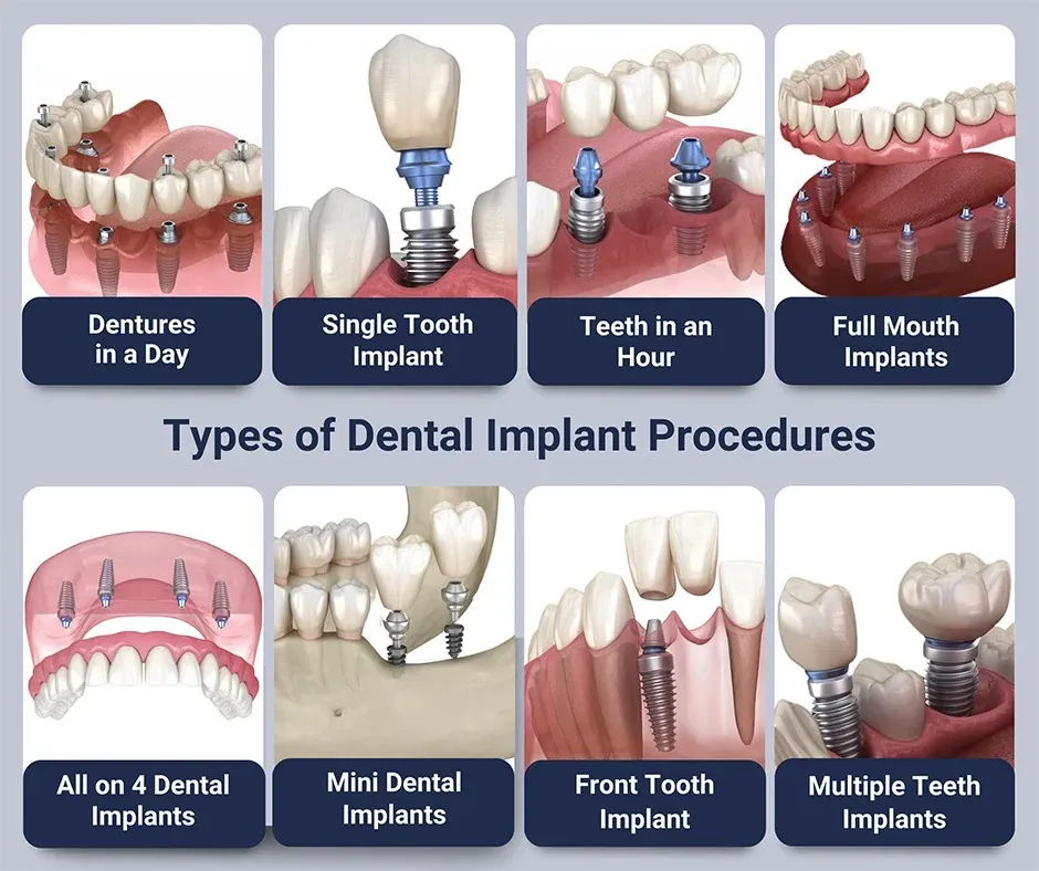 What Are Dental Implants