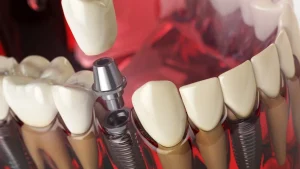 Denture Implants