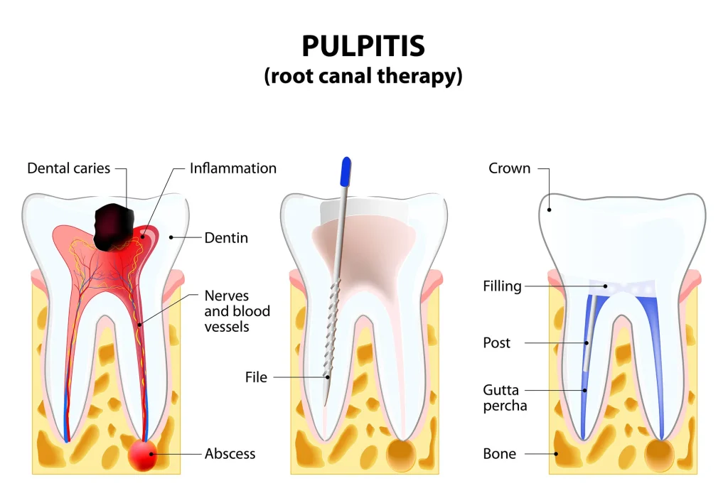 What Is Root Canal Treatment