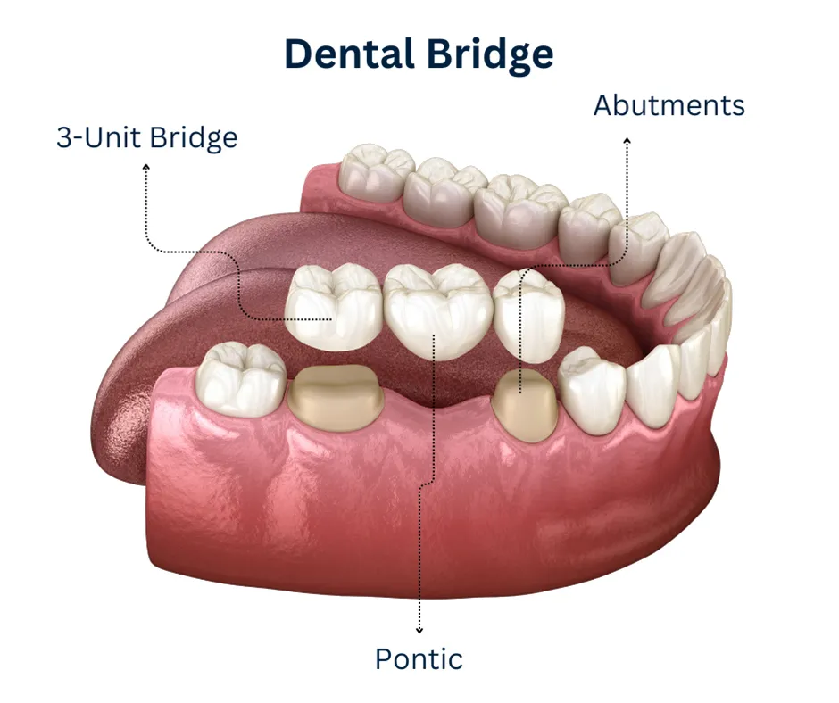 What Is a Dental Bridge