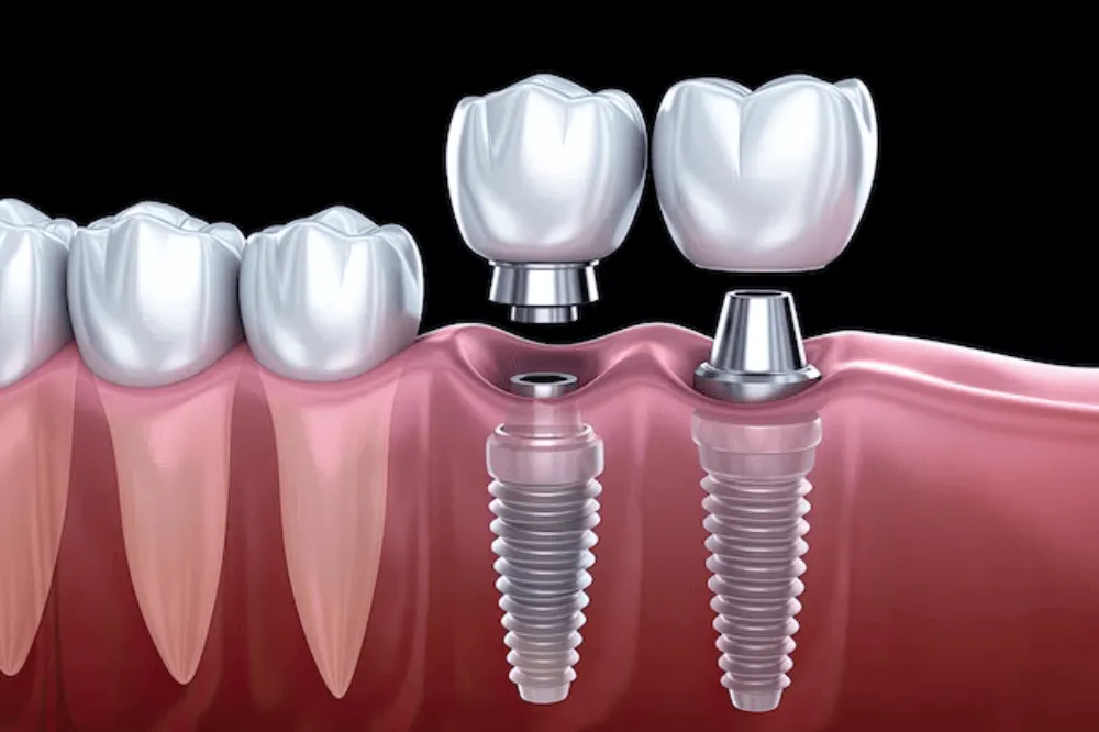 What Is a Dental Implant
