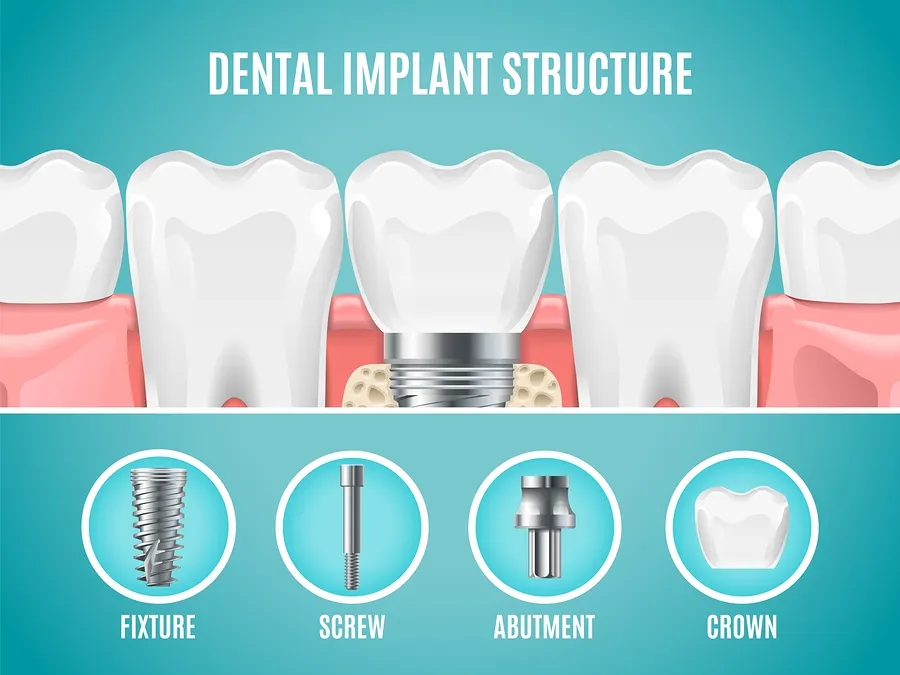 What Is a Dental Implant