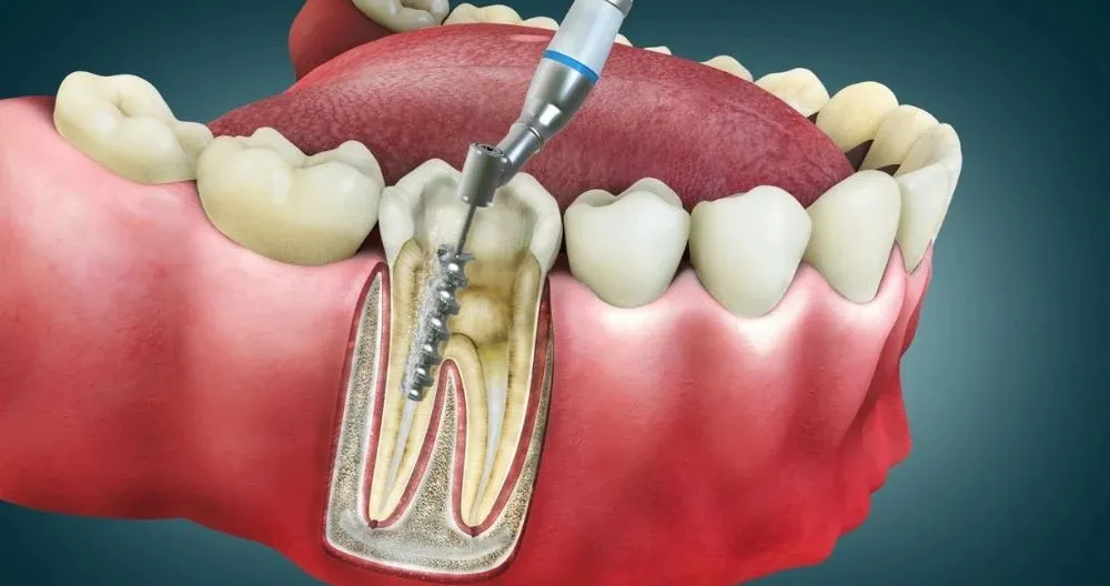 What Is a Root Canal