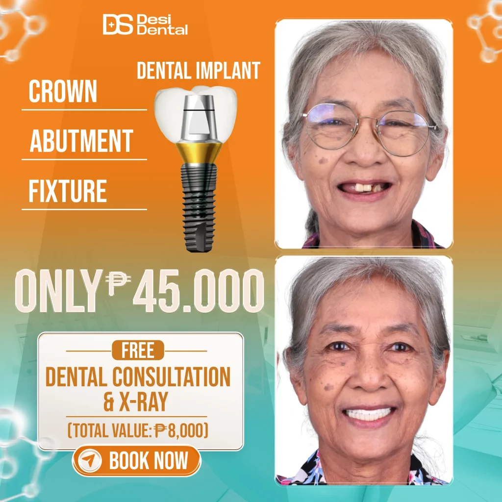 What are dental implants