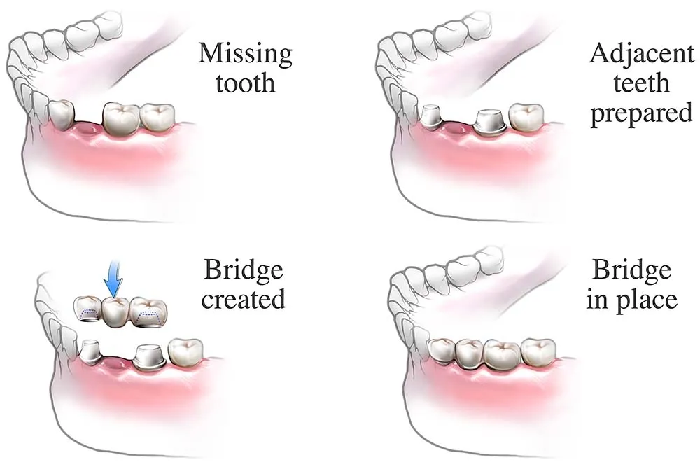 What is a Dental Bridge
