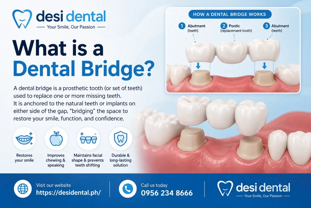What is a Dental Bridge