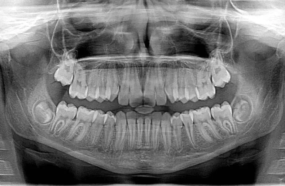 What is dental X-ray
