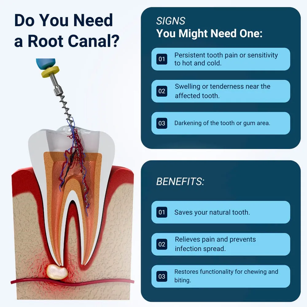 When Do You Need Root Canal Treatment