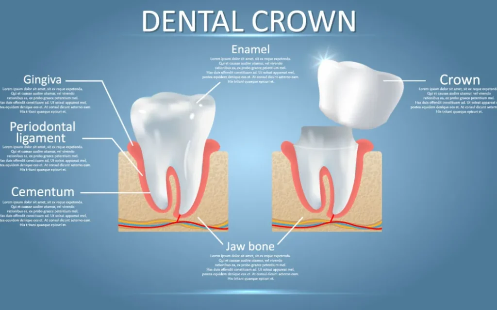 Why Choose Dental Crowns