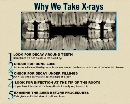 Why Dental X-Rays Are Important