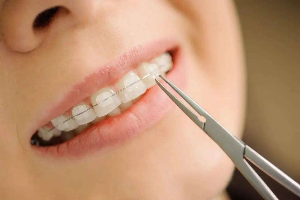 Why Many Patients Choose Ceramic Braces