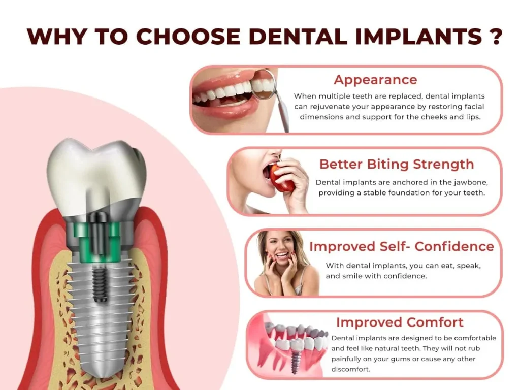 Why Many Patients Choose Dental Implants