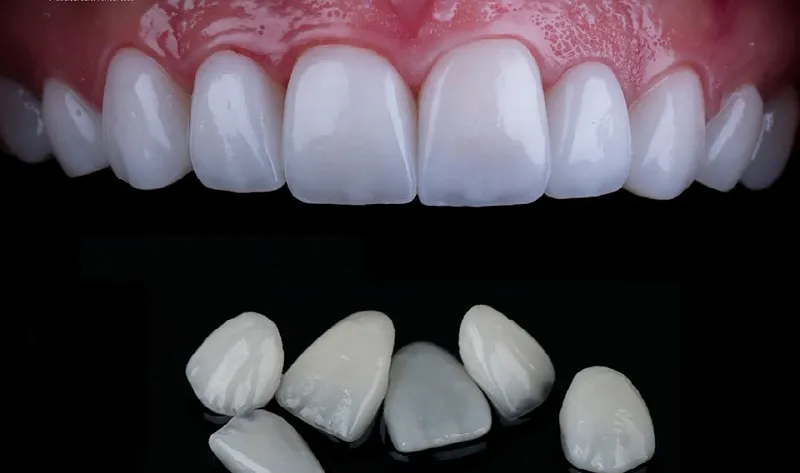 Zirconia Veneers